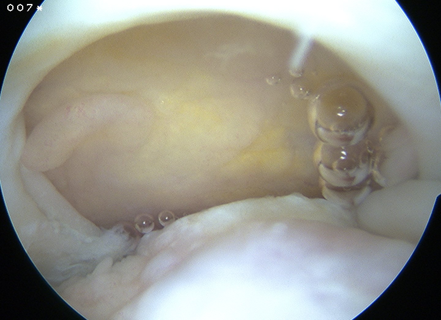 SS tear arthroscopy GHJ